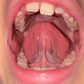 Fonoaudiología Frenillo y Motricidad Orofacial