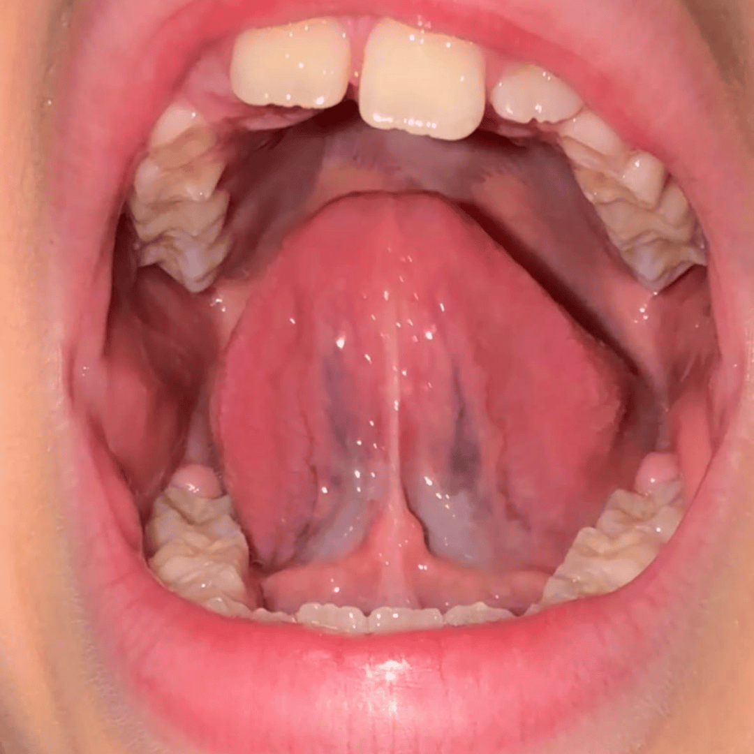 Fonoaudiología Frenillo y Motricidad Orofacial